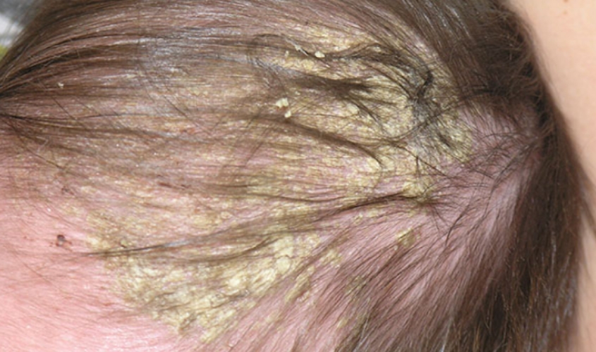 Cứt trâu hay viêm da tiết bã là tình trạng xuất hiện các vảy khô trên da đầu