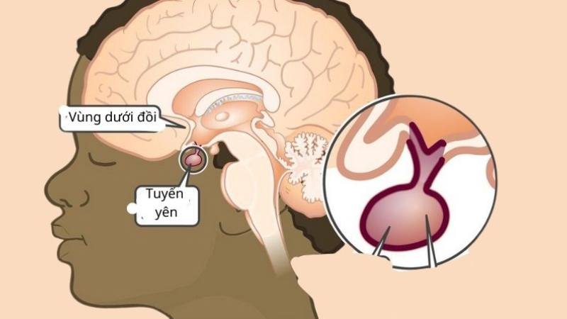 Vùng dưới đồi hoặc tuyến yên bị tổn thương gây đái tháo nhạt trung ương Vùng dưới đồi hoặc tuyến yên bị tổn thương gây đái tháo nhạt trung ương