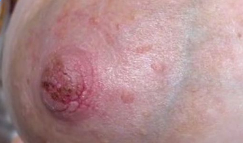 Hình ảnh nứt đầu ti