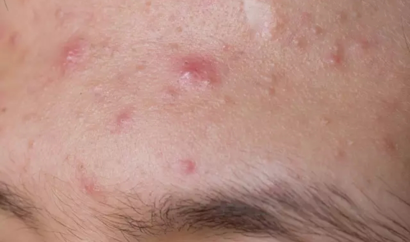 Mụn kích ứng là tình trạng da phản ứng tiêu cực với các yếu tố bên ngoài như mỹ phẩm, ánh nắng, ô nhiễm môi trường