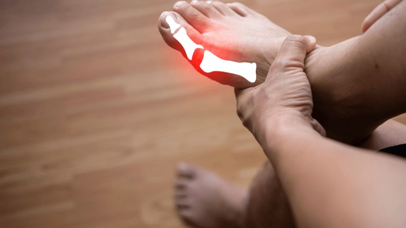 Gout là một dạng viêm khớp do tăng acid uric máu làm lắng đọng các tinh thể muối urat ở khớp, phần mềm cạnh khớp