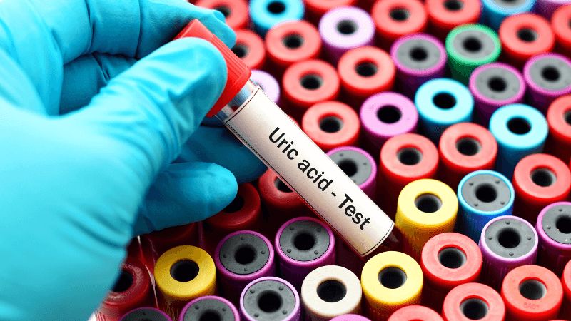 Bác sĩ sẽ chẩn đoán bệnh gout dựa trên thăm khám lâm sàng và các xét nghiệm cận lâm sàng giúp chẩn đoán chính xác hơn