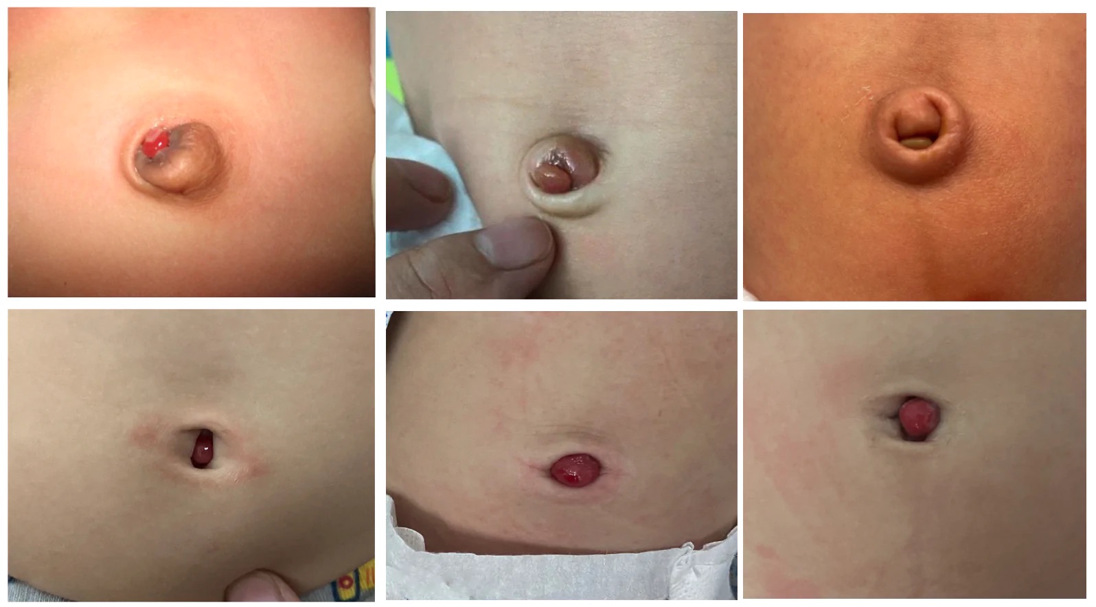 Hình ảnh u hạt rốn ở trẻ sơ sinh