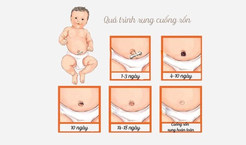 Quá trình rụng rốn ở trẻ sơ sinh