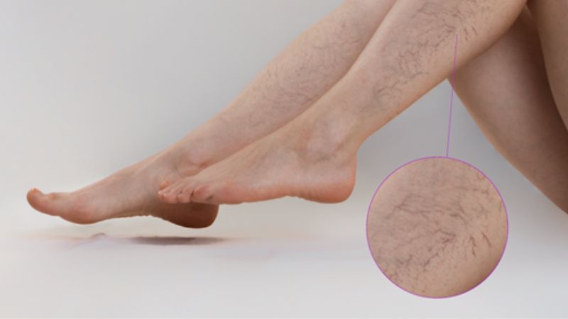 Người bệnh cần chăm sóc vết thương hở tránh tình trạng viêm loét da
