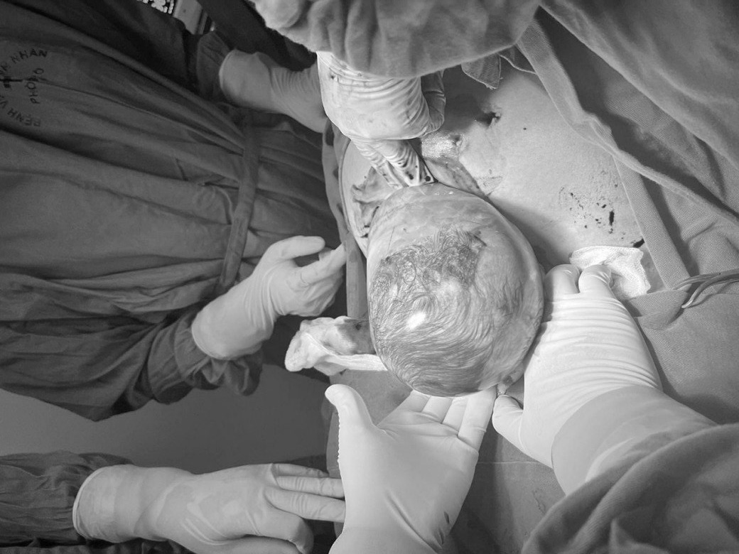 Nguyên nhân chính dẫn đến hiện tượng đẻ bọc điều là bọc ối của em bé này dày và dai hơn Nguyên nhân chính dẫn đến hiện tượng đẻ bọc điều là bọc ối của em bé này dày và dai hơn