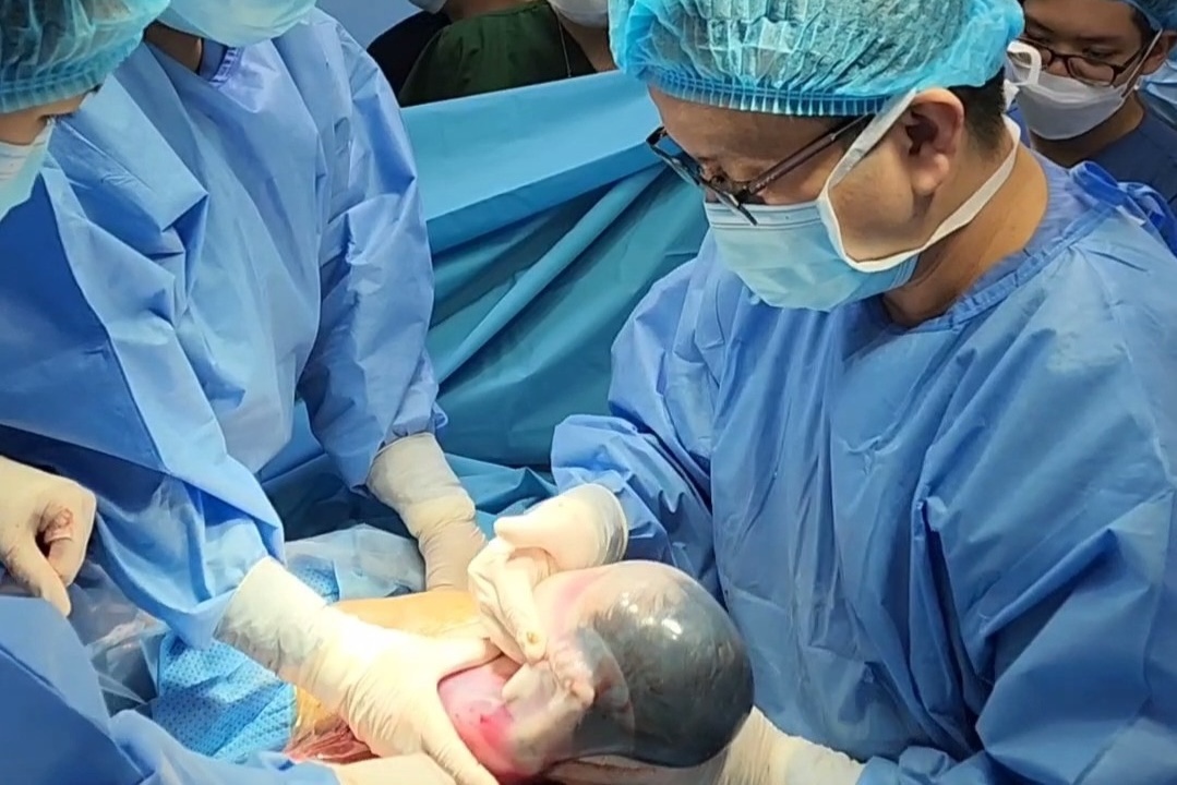 Đẻ bọc điều là hiện tượng trẻ chào đời vẫn nằm trong túi nước ối Đẻ bọc điều là hiện tượng trẻ chào đời vẫn nằm trong túi nước ối