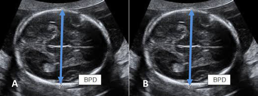 Đường kính lưỡng đỉnh nhỏ hơn kích thước chuẩn có thể do bào thai bị chậm phát triển