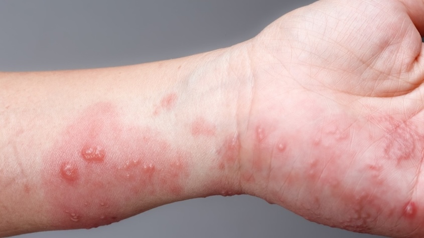 Ghẻ nước: Nguyên nhân, triệu chứng