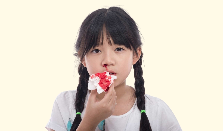 Chảy máu cam ở trẻ do lớp niêm mạc bên trong mũi bị tổn thương