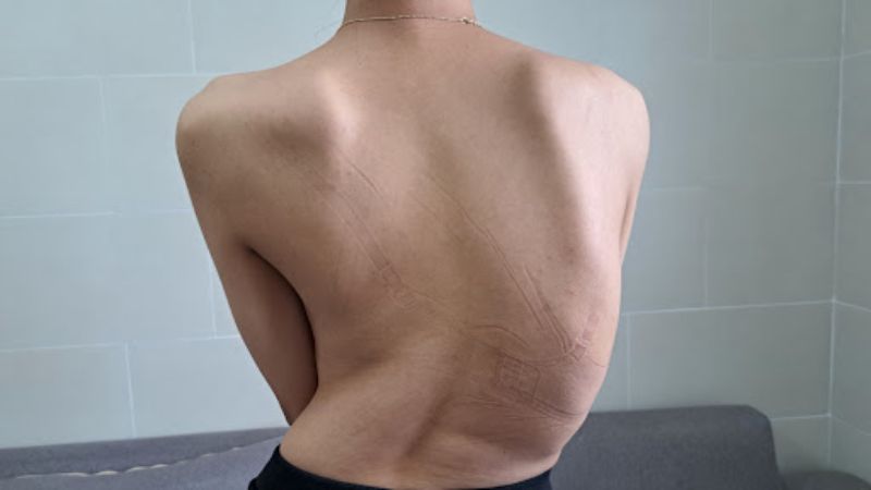 Người bệnh nên tới gặp bác sĩ khi có biểu hiện cong, vẹo cột sống Người bệnh nên tới gặp bác sĩ khi có biểu hiện cong, vẹo cột sống