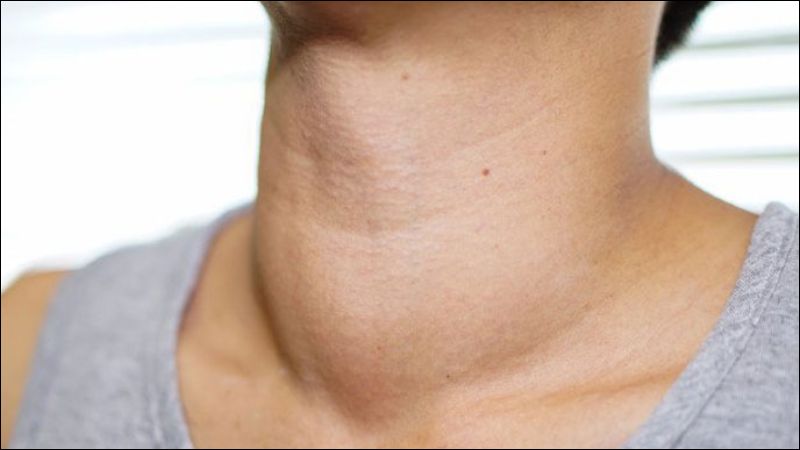 Loãng xương thứ phát có thể xảy ra sau khi mắc bệnh cường giáp Loãng xương thứ phát có thể xảy ra sau khi mắc bệnh cường giáp