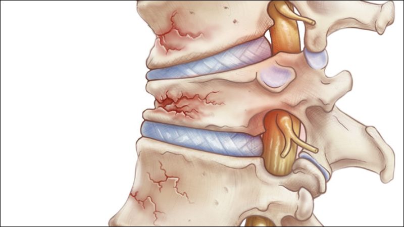 Gãy, xẹp đốt sống là biến chứng thường gặp của loãng xương Gãy, xẹp đốt sống là biến chứng thường gặp của loãng xương