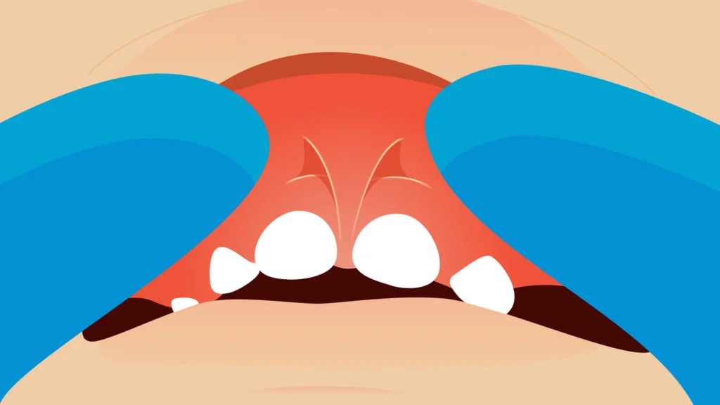 Biểu hiện của dính thắng môi trên