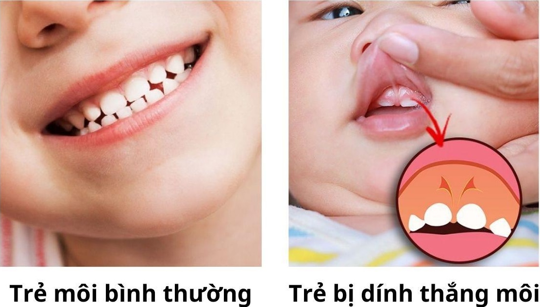 Hình ảnh thắng môi trên bình thường