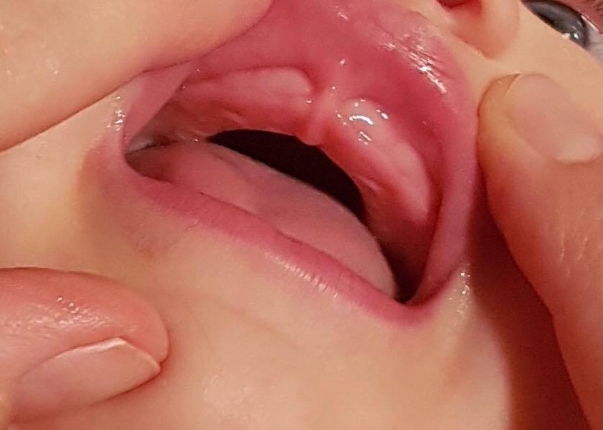 Hình ảnh nhận biết dính thắng môi trên