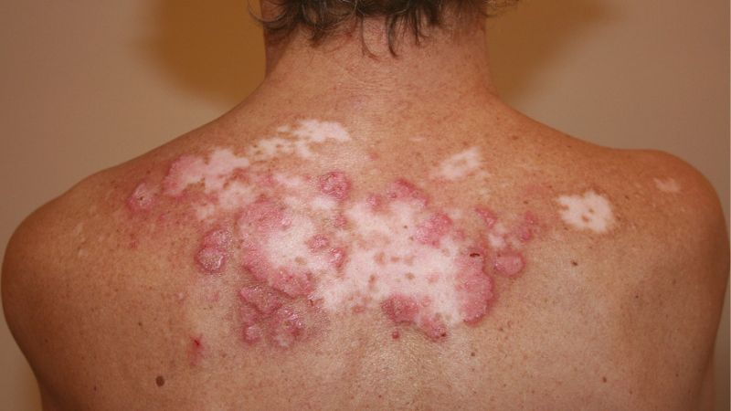 Lupus ban đỏ do tổn thương loét thường xuất hiện nhiều ở vị trí bắt nắng Lupus ban đỏ do tổn thương loét thường xuất hiện nhiều ở vị trí bắt nắng