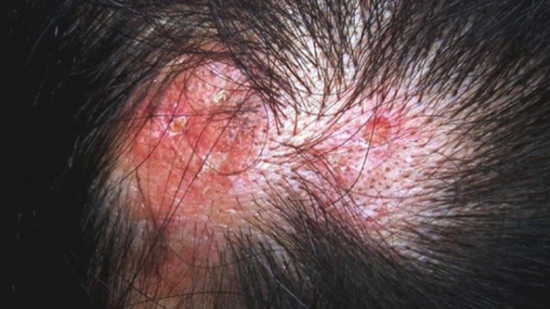 Lupus ban đỏ có thể gây nên rụng tóc không mọc lại Lupus ban đỏ có thể gây nên rụng tóc không mọc lại