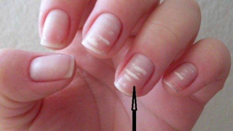 Lupus ban đỏ có thể gây nứt móng tay Lupus ban đỏ có thể gây nứt móng tay