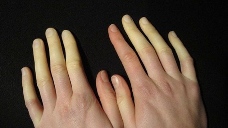 Lupus ban đỏ có thể dẫn tới hội chứng Raynaud Lupus ban đỏ có thể dẫn tới hội chứng Raynaud