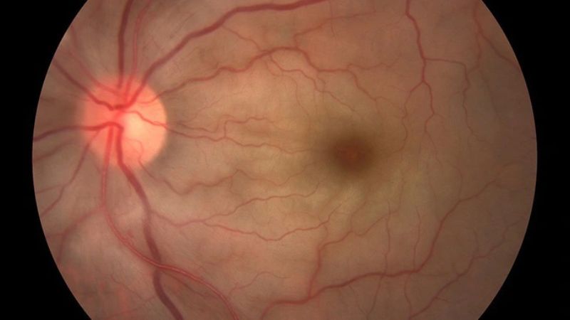 Lupus ban đỏ gây hạn chế cấp máu đến võng mạc Lupus ban đỏ gây hạn chế cấp máu đến võng mạc