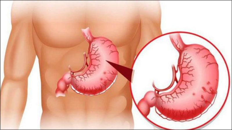 Tăng áp lực tĩnh mạch cửa