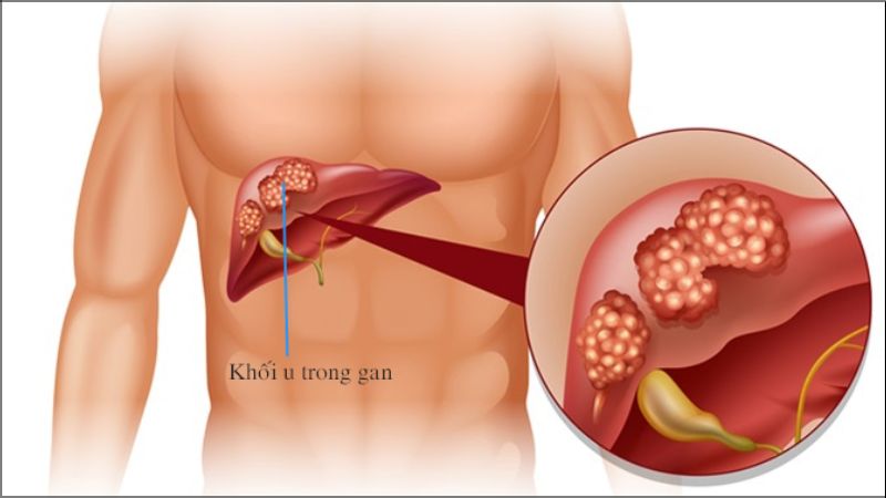 Nghiên cứu ghi nhận những bệnh nhân ung thư gan thường có tiền căn xơ gan trước đây