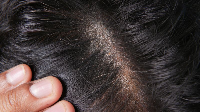 Saponin trong bồ kết có khả năng hỗ trợ điều trị nấm da đầu
