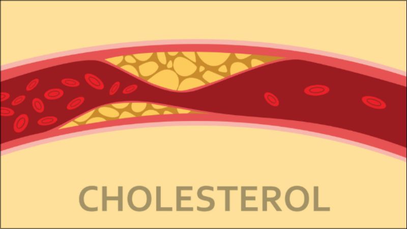 Người c&oacute; cholesterol cao