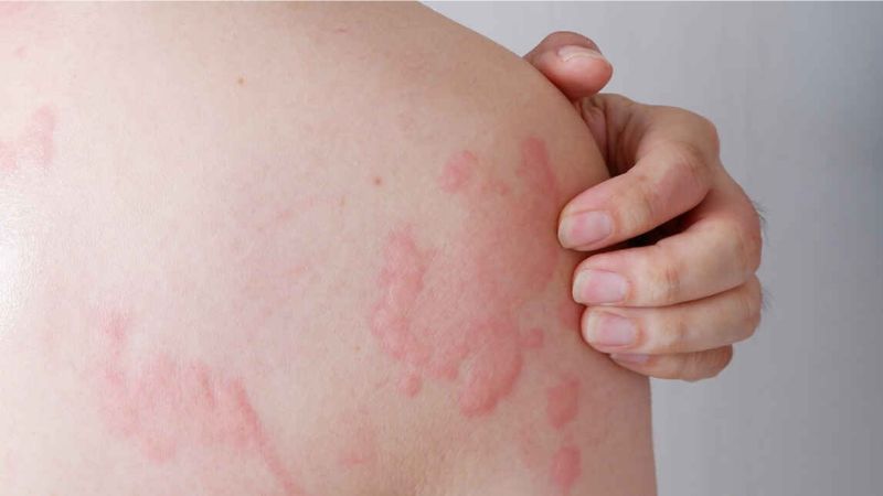 Ngưng ăn thanh long ngay khi phát hiện các dấu hiệu dị ứng