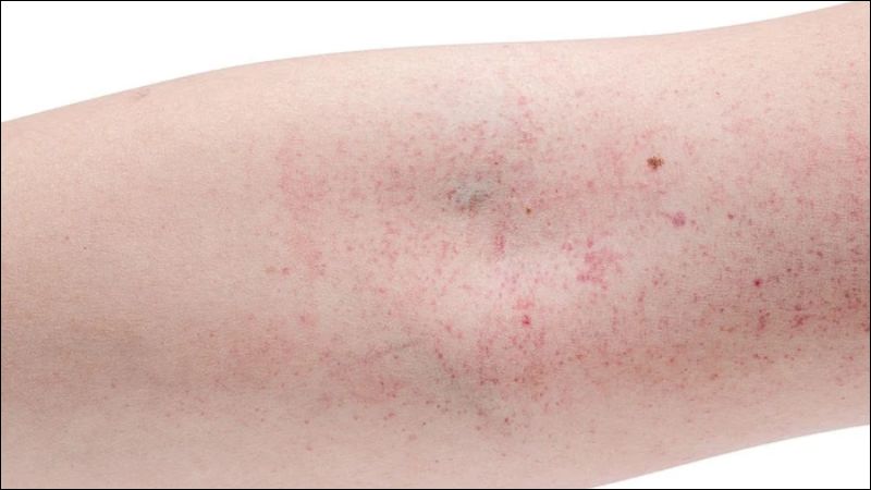 Nổi ban xuất huyết dưới da là một trong những dấu hiệu của hội chứng Weil