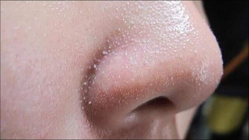 Sợi bã nhờn là các cấu trúc tự nhiên nằm sâu trong nang lông hoặc xuất hiện trên bề mặt da