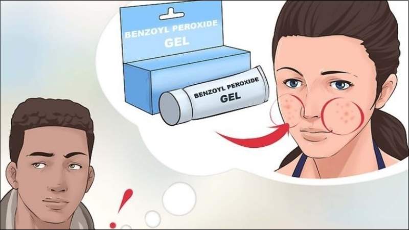 Benzoyl peroxide giúp kiểm soát dầu thừa, làm khô bã nhờn 