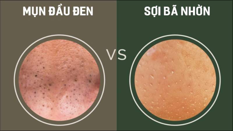Sợi bã nhờn và mụn đầu đen có nhiều điểm khác biệt