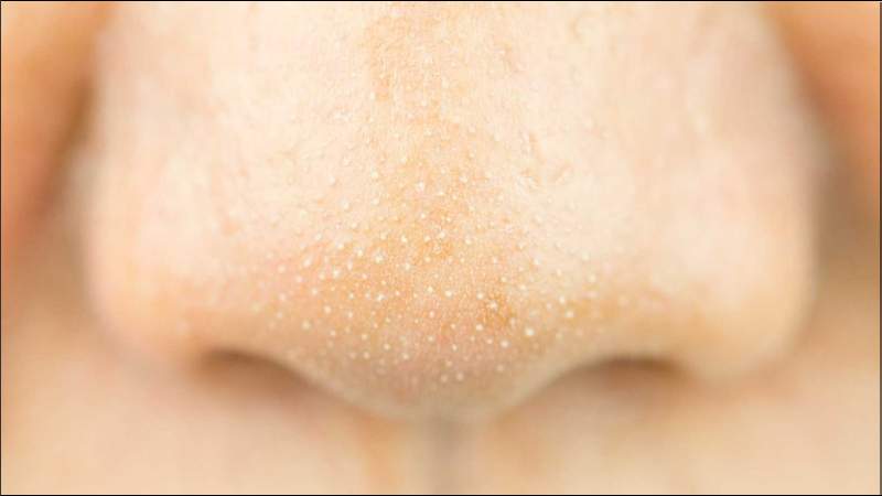 Có nhiều nguyên nhân gây ra tình trạng sợi bã nhờn 