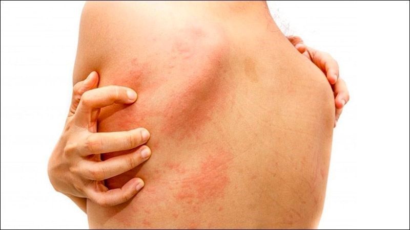 Thuốc giảm cân gây ngứa, dị ứng ở một số người mẫn cảm với thuốc