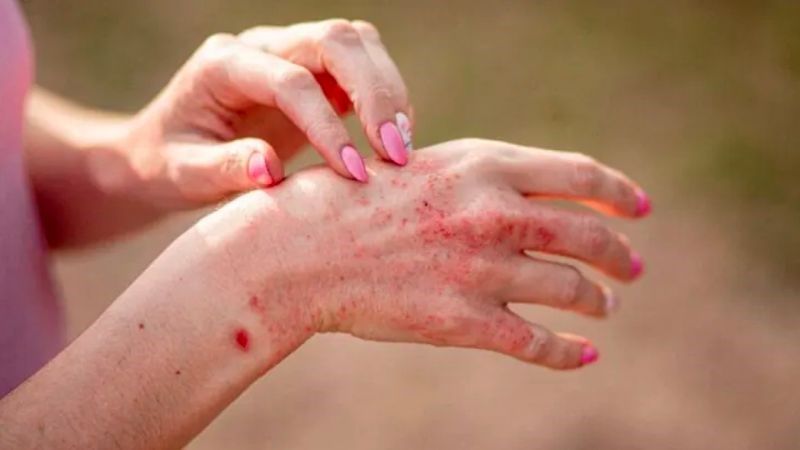 Viêm da do cơ thể không có đủ khả năng chuyển hoá và đào thải các chất