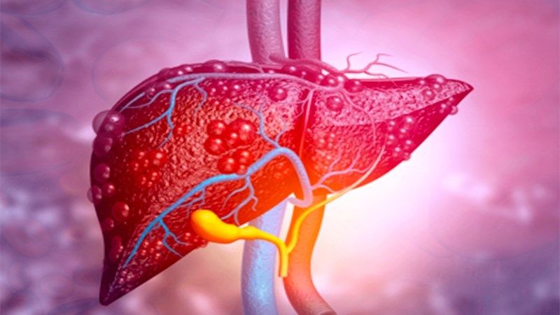 Gan tổn thương do tác động của thuốc giảm cân