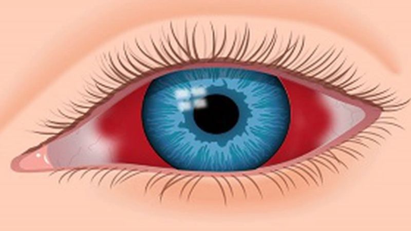 Xuất huyết dưới kết mạc mắt là tình trạng xuất hiện máu ở lòng trắng Xuất huyết dưới kết mạc mắt là tình trạng xuất hiện máu ở lòng trắng