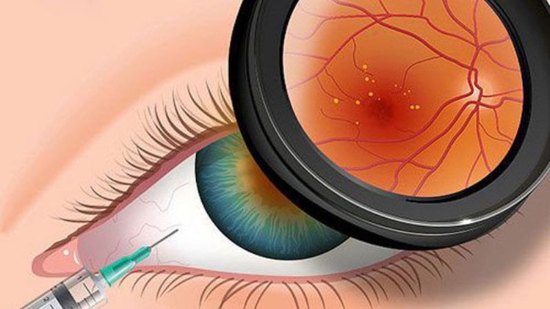 Các chất chống oxy hóa trong thuốc có thể hỗ trợ bệnh thoái hóa điểm vàng