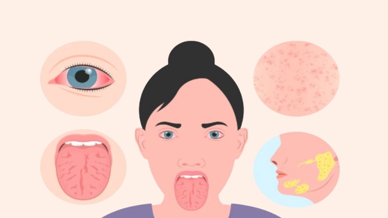 Người mắc hội chứng Sjogren thường gặp tình trạng khô môi Người mắc hội chứng Sjogren thường gặp tình trạng khô môi