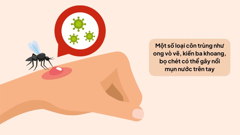 Một số loài côn trùng cắn làm xuất hiện mụn nước ở tay Một số loài côn trùng cắn làm xuất hiện mụn nước ở tay