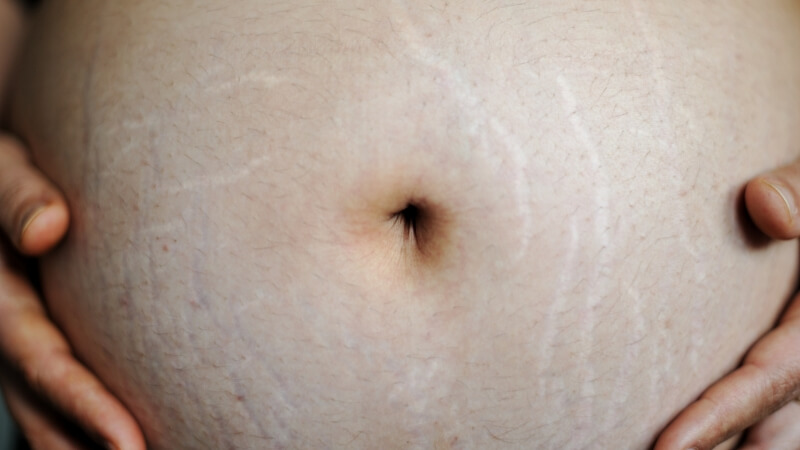 Phụ nữ mang thai có khả năng cao bị rạn da Phụ nữ mang thai có khả năng cao bị rạn da