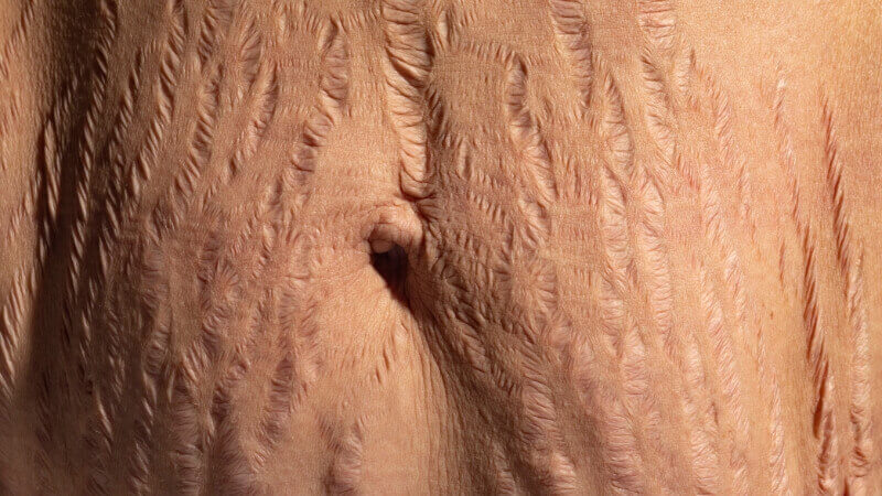 Những vết rạn nhăn nheo khiến nhiều người cảm thấy tự ti Những vết rạn nhăn nheo khiến nhiều người cảm thấy tự ti