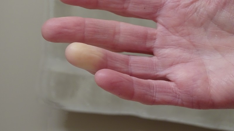 Hội chứng Raynaud khiến c&aacute;c ng&oacute;n tay, ng&oacute;n ch&acirc;n lạnh đột ngột