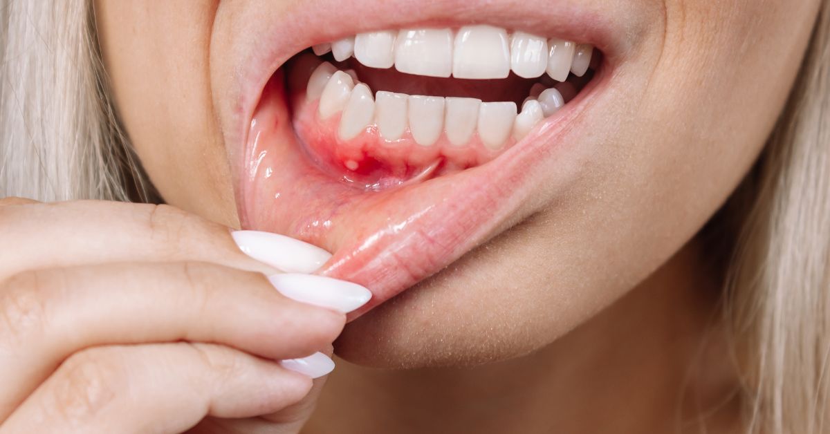 Bạn cần kh&aacute;m b&aacute;c sĩ khi nhiệt miệng t&aacute;i ph&aacute;t nhiều lần