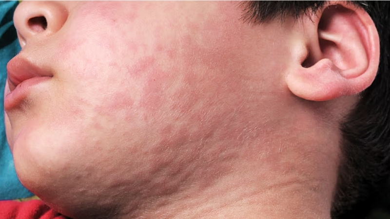 Triệu chứng rõ ràng nhất của sốc phản vệ thể hiện trên da và hô hấp Triệu chứng rõ ràng nhất của sốc phản vệ thể hiện trên da và hô hấp