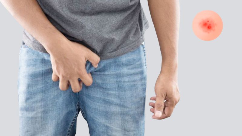 Dương vật nổi mụn đỏ l&agrave; t&igrave;nh trạng xuất hiện c&aacute;c nốt đỏ, sẩn nhỏ hoặc mụn li ti tr&ecirc;n da dương vật