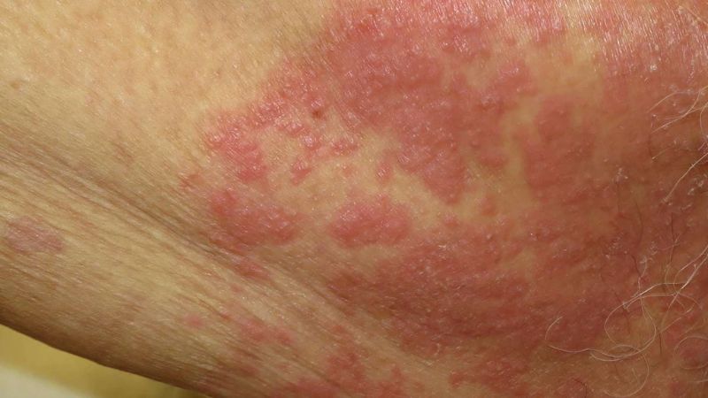Nhiễm nấm Candida l&agrave; một trong những nguy&ecirc;n nh&acirc;n g&acirc;y nổi mụn đỏ ở dương vật