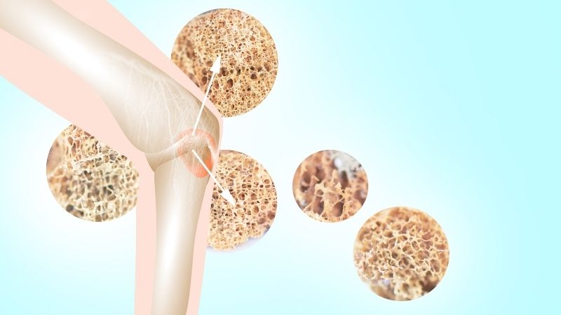 Hàm lượng boron và canxi trong nho khô giúp ngăn ngừa tình trạng loãng xương hiệu quả